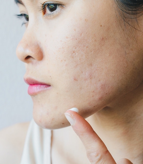 Acne scars on a young woman's face