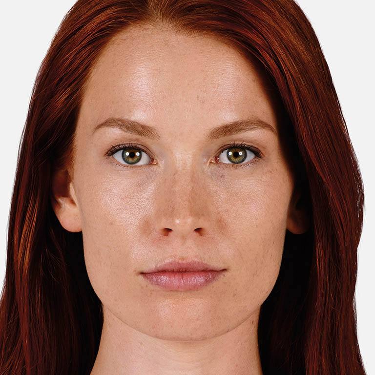 Woman's face after Juvederm treatment
