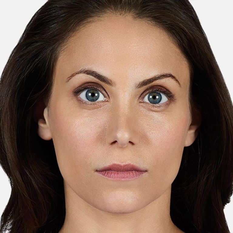 Woman's face before Juvederm treatment