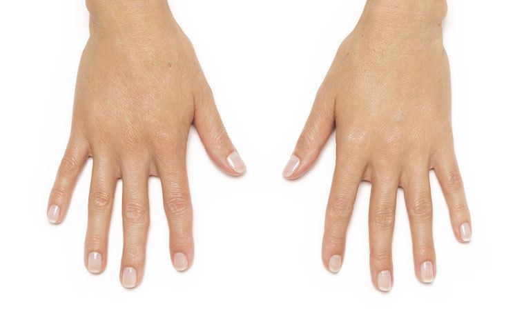 A patient's hands after Radiesse treatment