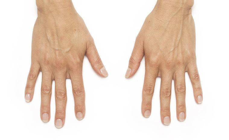 A patient's hands before Radiesse treatment