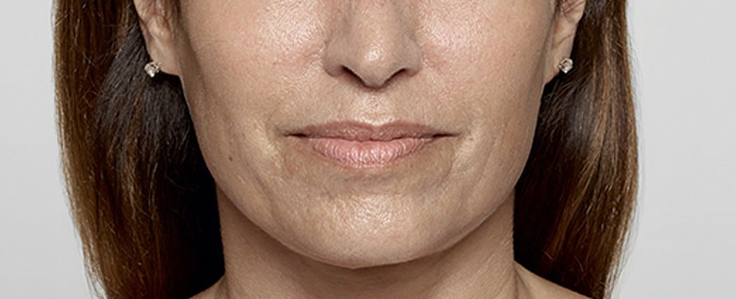 A patient's face before Restylane treatment