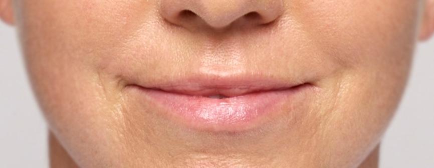 A patient's face after Restylane treatment