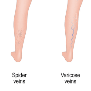 Diagram showing the difference between spider and varicose veins