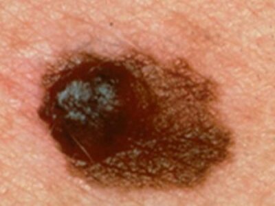 Close Look At A Skin Cancer Mole