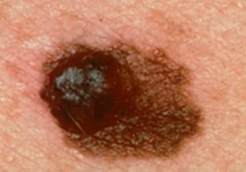Close look at a skin cancer mole