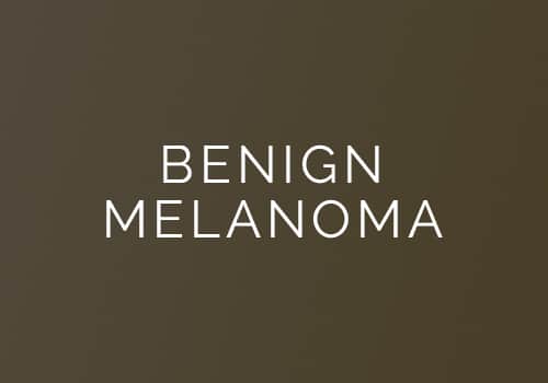 Benign Melanoma banner
