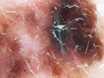 Close Look At Skin Cancer