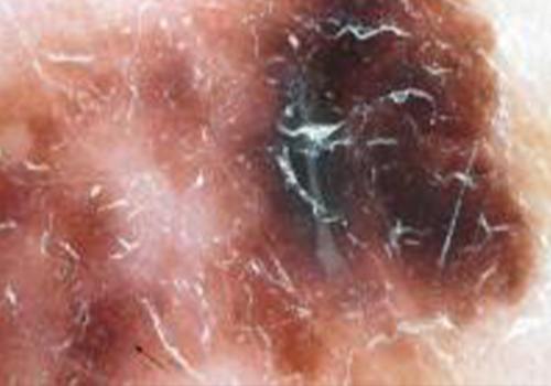 Close look at skin cancer