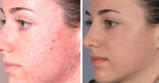 A Young Woman's Face Before And After Her Microdermabrasion Procedure
