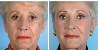 A Woman's Face Before And After Her Microdermabrasion Procedure