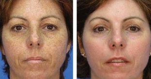 A Middle-aged Woman's Face Before And After Her Microdermabrasion Procedure