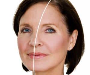 Before and after look at a woman's face who underwent treatment
