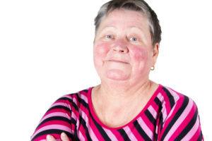 Older woman with rosacea