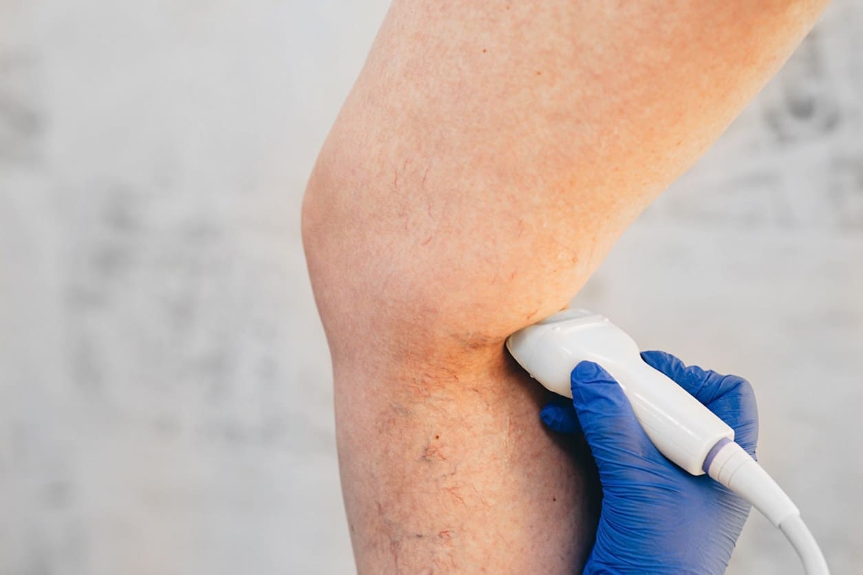 Dermatologist inspecting veins on a patient's leg