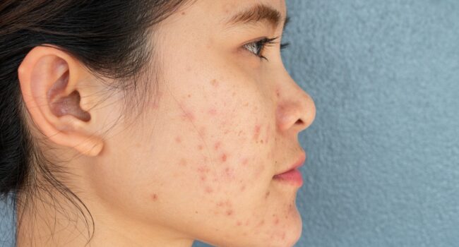 Side View Of Woman Half Face With Problems Of Acne Inflammation (Papule And Pustule) On Her Cheek.