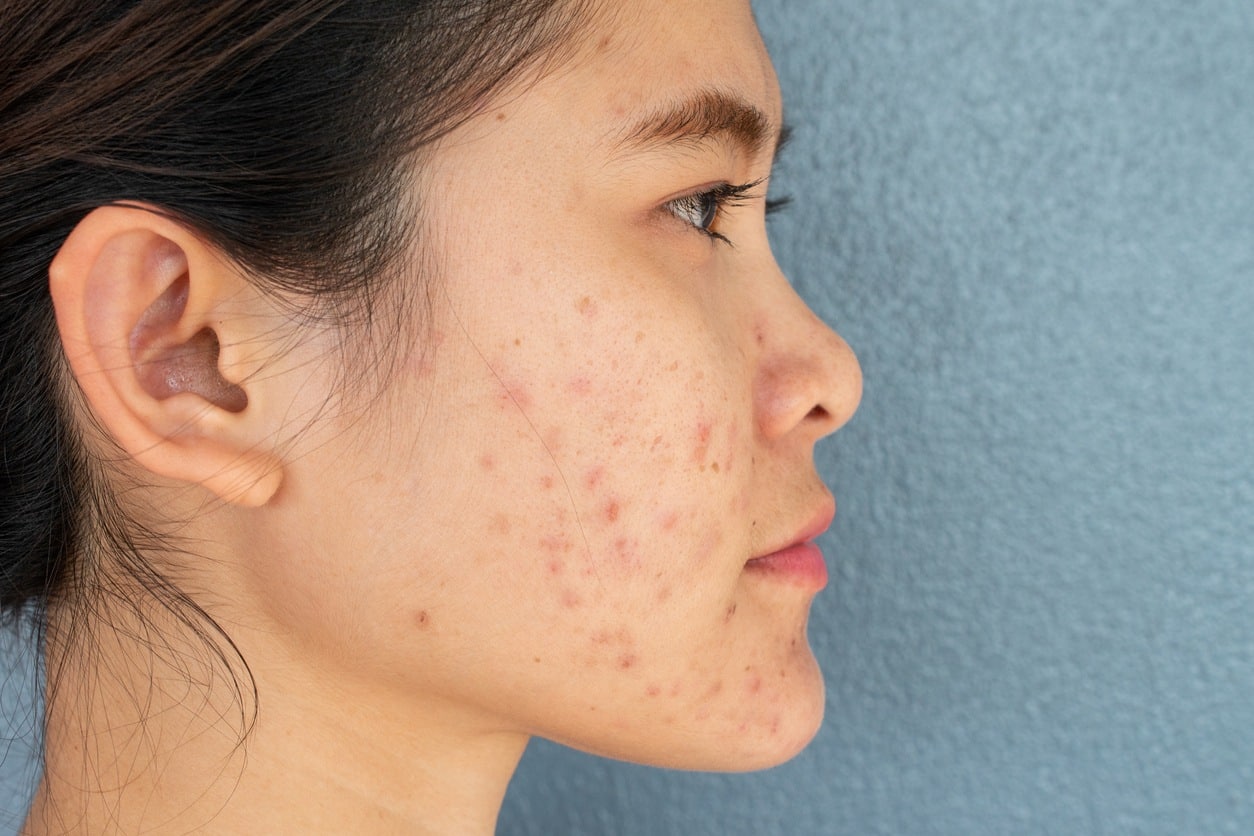 Side view of woman half face with problems of acne inflammation (Papule and Pustule) on her cheek.