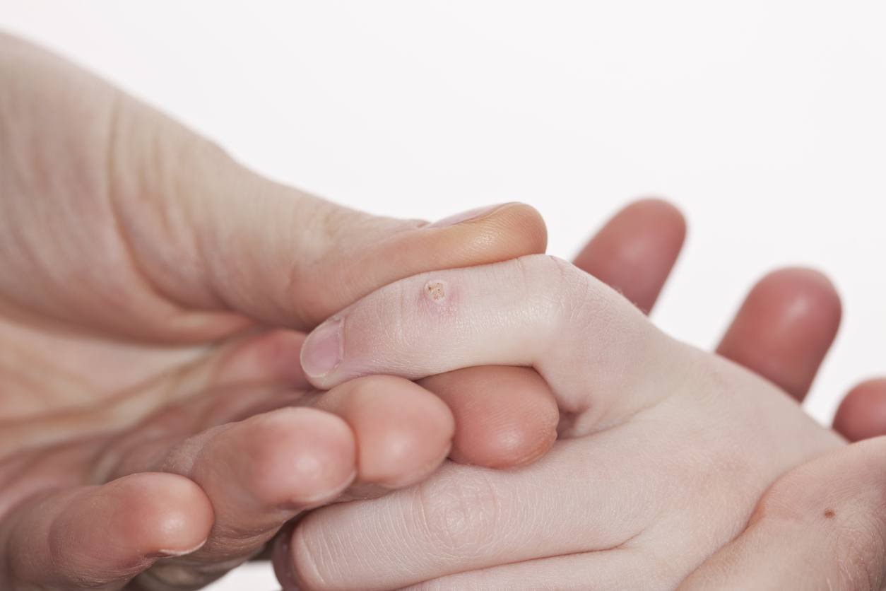 An adult holds the hand of a child with a macro wart