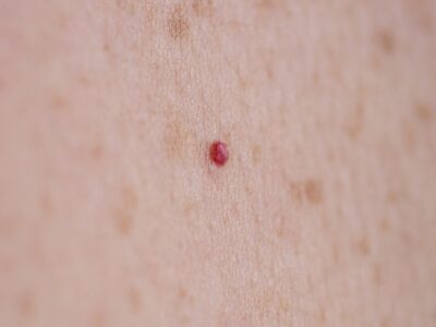 Red Mole On A Patient's Back