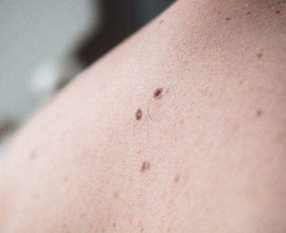 Hairy mole on a patient's back
