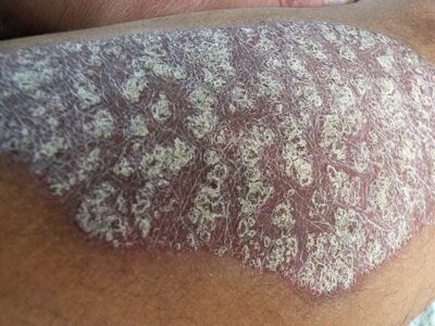 A Severe Case Of Psoriasis On A Patient's Leg