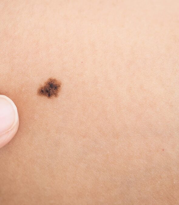 Woman pointing to a mole on her skin