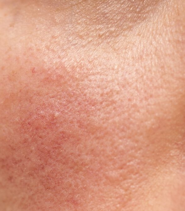 Rosacea on human skin, closeup