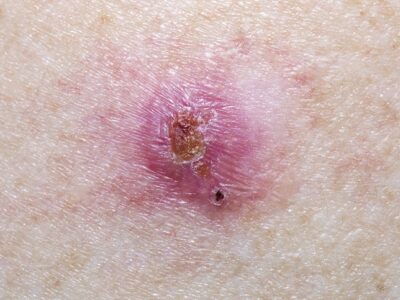 Infected Basal Cell Carcinoma Mole