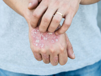 A Woman With Eczema On Her Hand