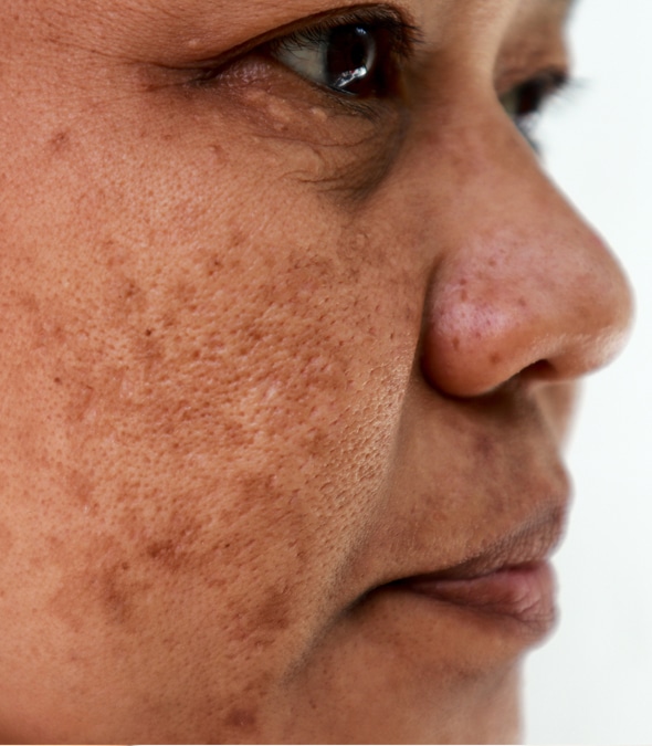 Older woman with facial melasma
