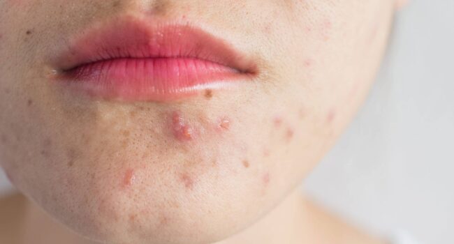 Woman With Acne On Her Face Before Treatment
