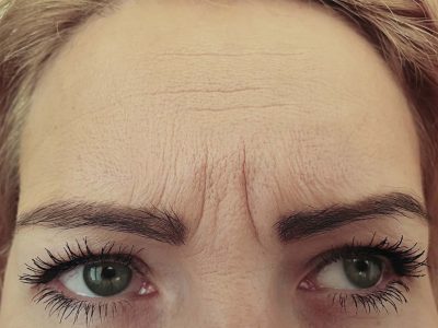 Forehead Wrinkles On A Woman Before Treatment