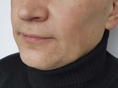 A Man With Reduced Facial Wrinkles After Treatment