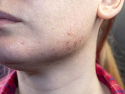 Close Up Of A Woman's Face Highlighting Acne On The Chin