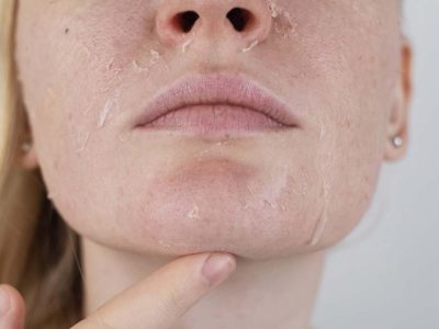 Close Up Of A Woman's Face Showcasing Dry And Irritated Skin