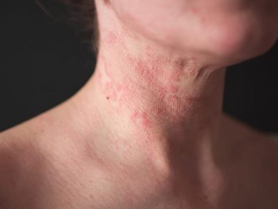 A Woman With Eczema On Her Neck