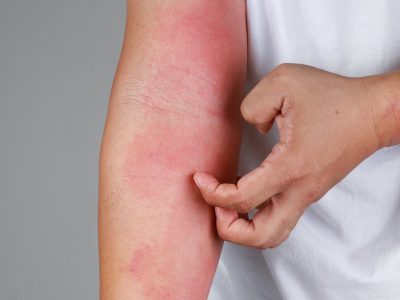 Eczema On The Elbow