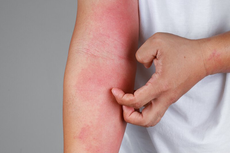 Eczema on the elbow
